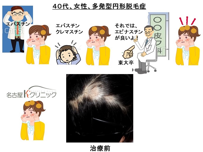 円形脱毛症　病院